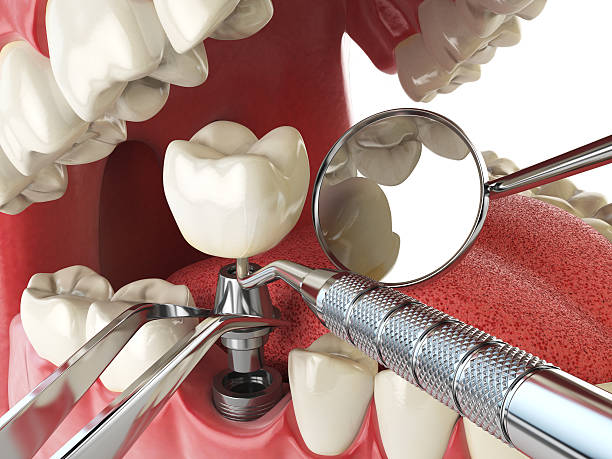 Best Emergency Denture Repair in New Lisbon, WI